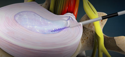 Percutaneous Disc System Stryker